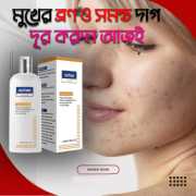 ব্রণ এবং দাগ দূর করার ক্লিনজিং লোশন (2)